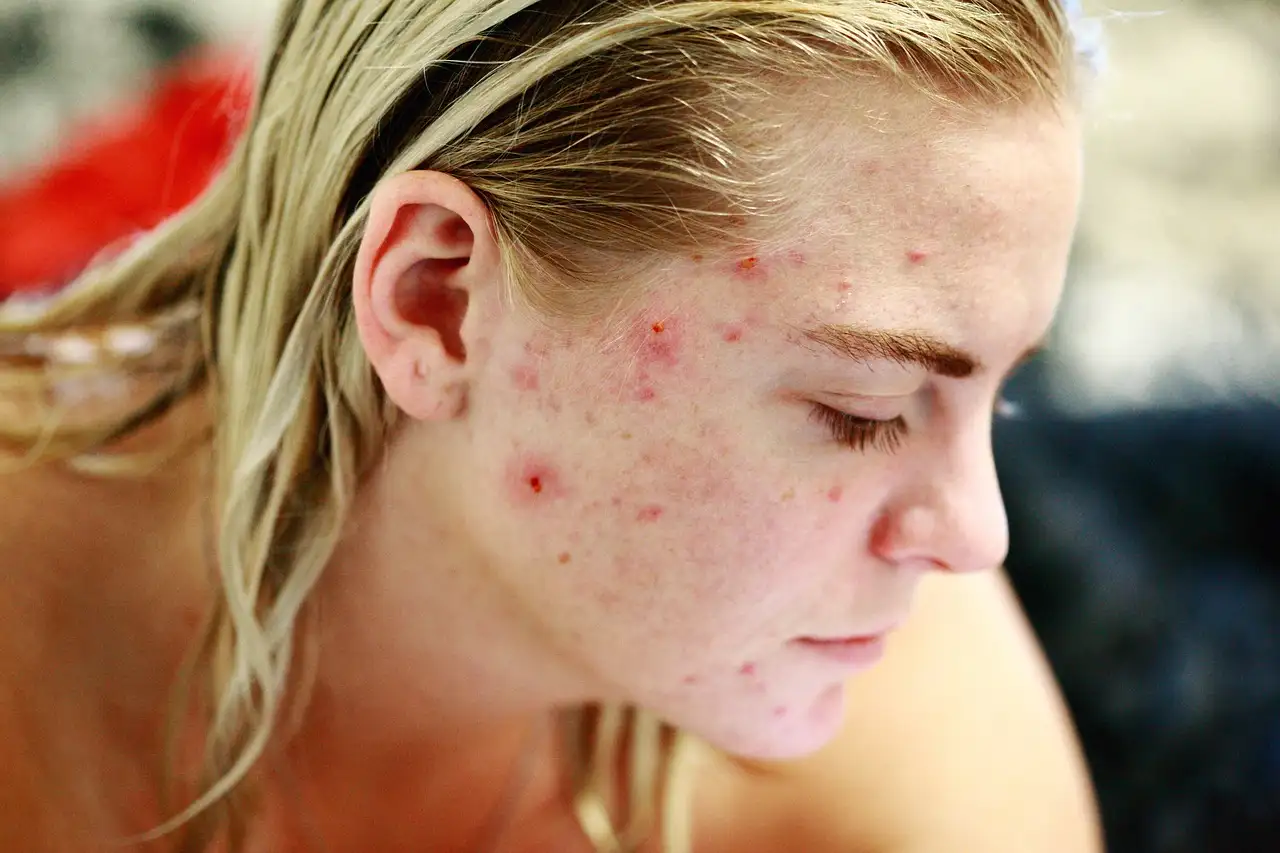 Como prevenir acne e outros problemas de pele de forma eficaz?